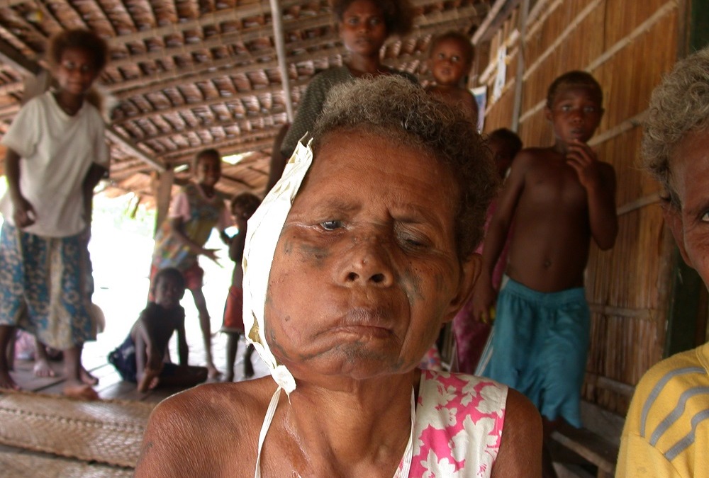 Solomon Islands, betelnut cancer, 2003